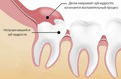 Капюшон над зубом фото Удаление капюшона над зубом мудрости