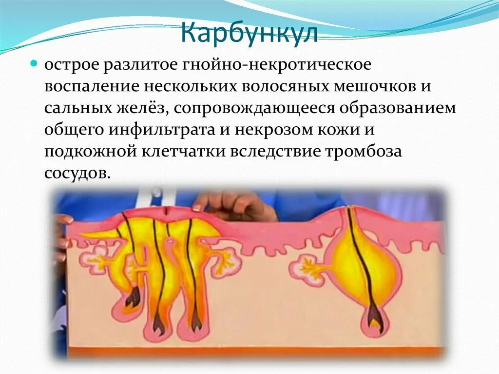 Карбункул фото как выглядит Воспаление плоти у мужчин причины и лечение - найдено 87 фото