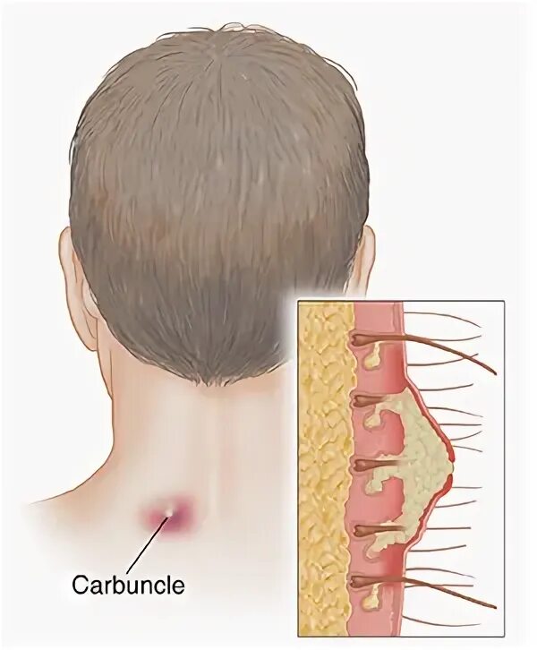 Карбункул фото как выглядит Understanding Carbuncles