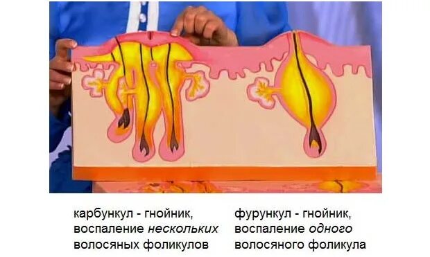 Карбункул фото как выглядит Карбункул и фурункул отличие - Olphoto.ru