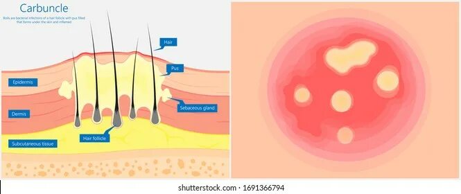 Карбункул фото как выглядит 18,673 Skin Boils Images, Stock Photos, 3D objects, & Vectors Shutterstock