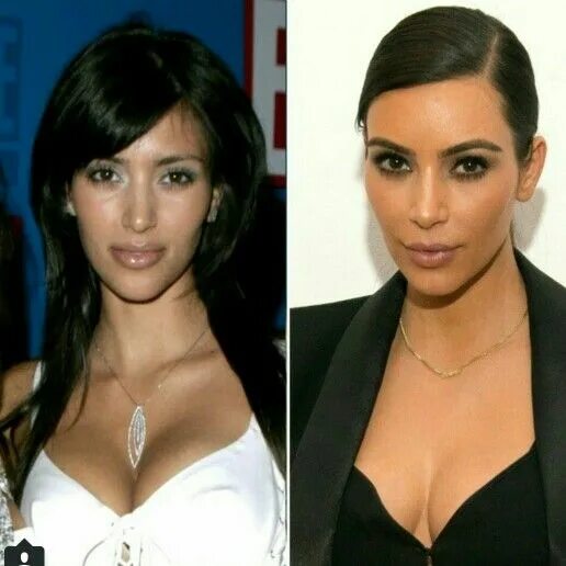 Кардашьян до пластики и после фото Before and after #kim #kardashian #plastic #surgery Kim kardashian surgery, Kim 