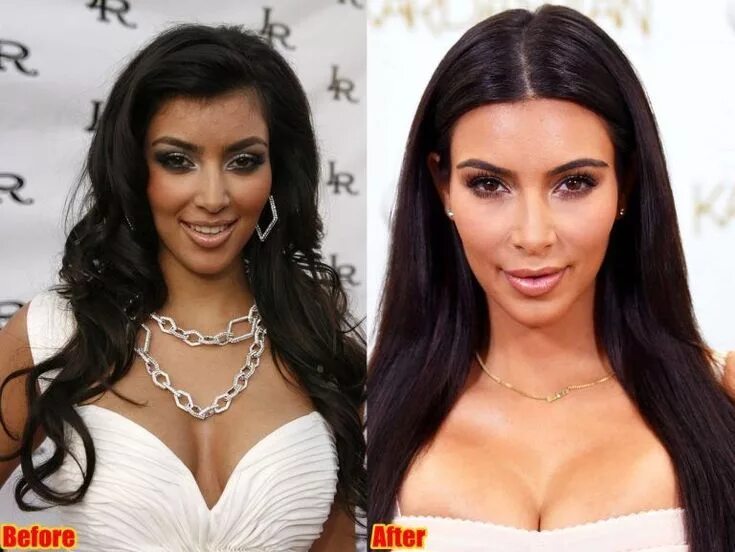 Кардашьян до пластики и после фото Kim Kardashian Face Surgery Before And After Photos #LipFillersIdeas - My Blog K