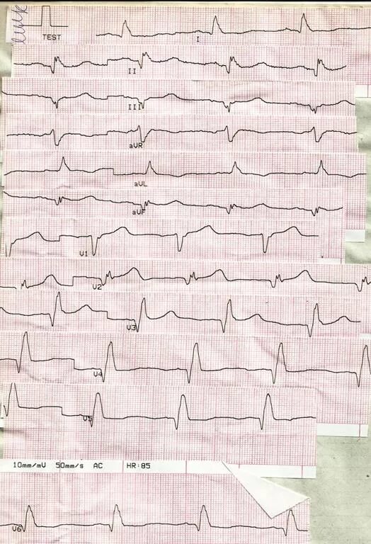 Кардиограмма сердца при инфаркте фото Студопедия - АТЛАС ЭКГ. Наблюдения позволяют сделать вывод, что большую часть св