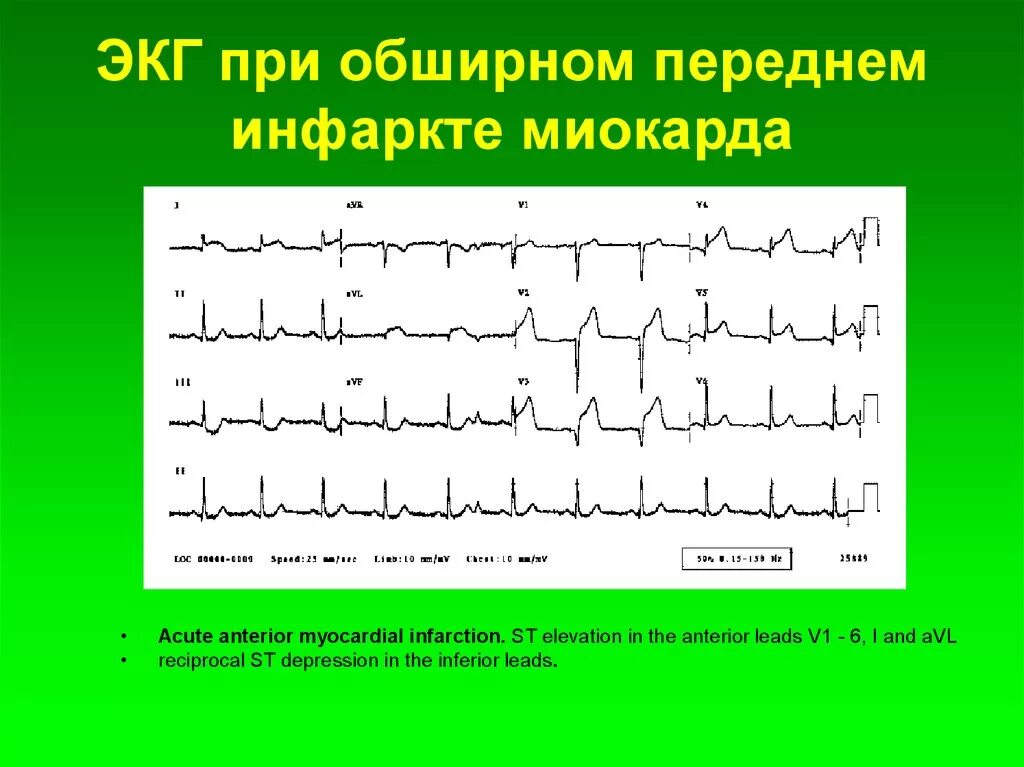 Кардиограмма сердца при инфаркте фото Покажет экг после