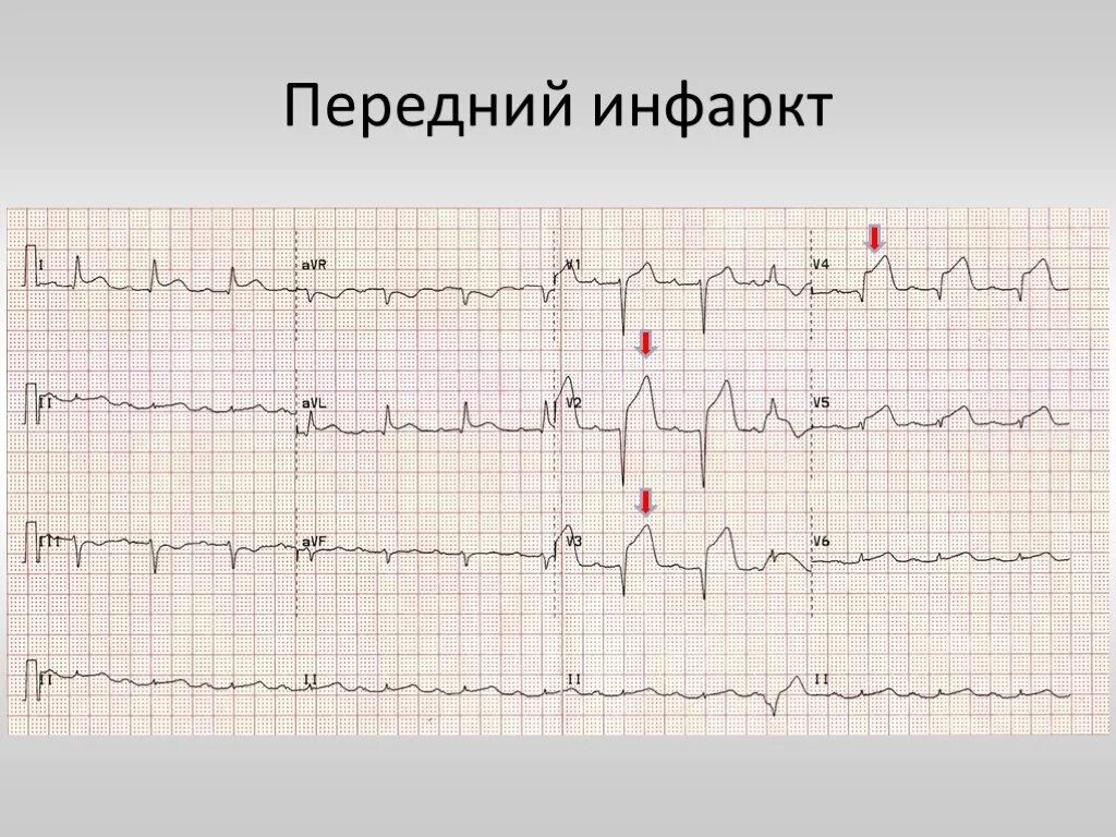 Кардиограмма сердца при инфаркте фото Презентация "ЭКГ-диагностика при подозрении на инфаркт миокарда" - скачать проек