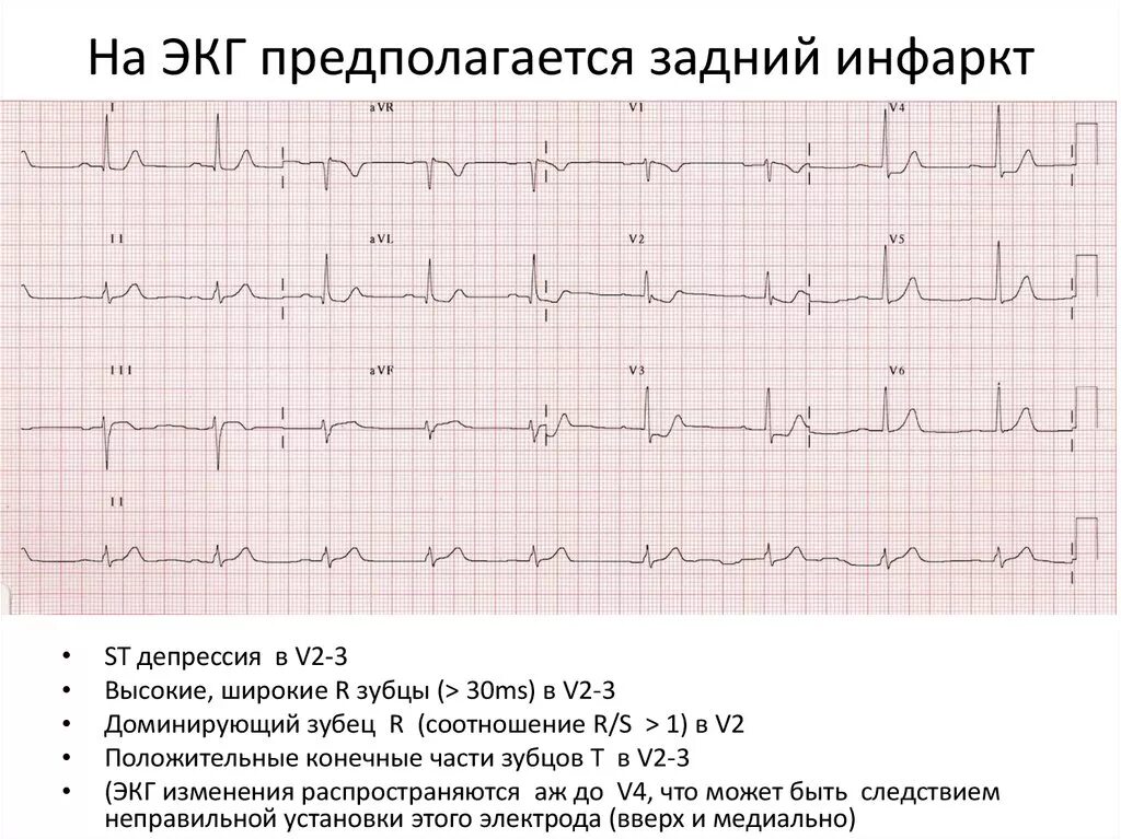 Кардиограмма сердца при инфаркте фото Экг после: найдено 85 изображений