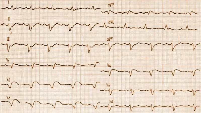 Кардиограмма сердца при инфаркте фото Ответы Mail.ru: Что вы видите на данной кардиограмме, уважаемые доктора