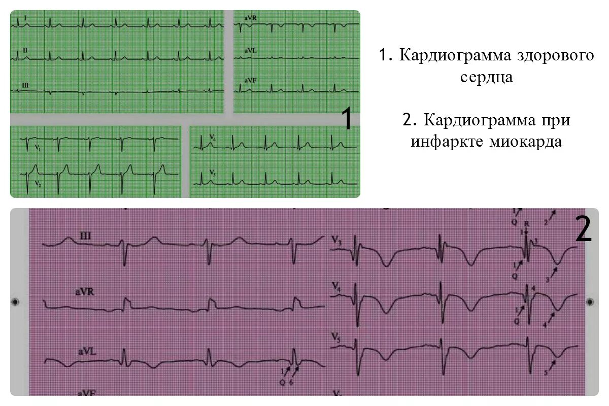 Кардиограмма сердца при инфаркте фото Экг сердца: найдено 74 изображений