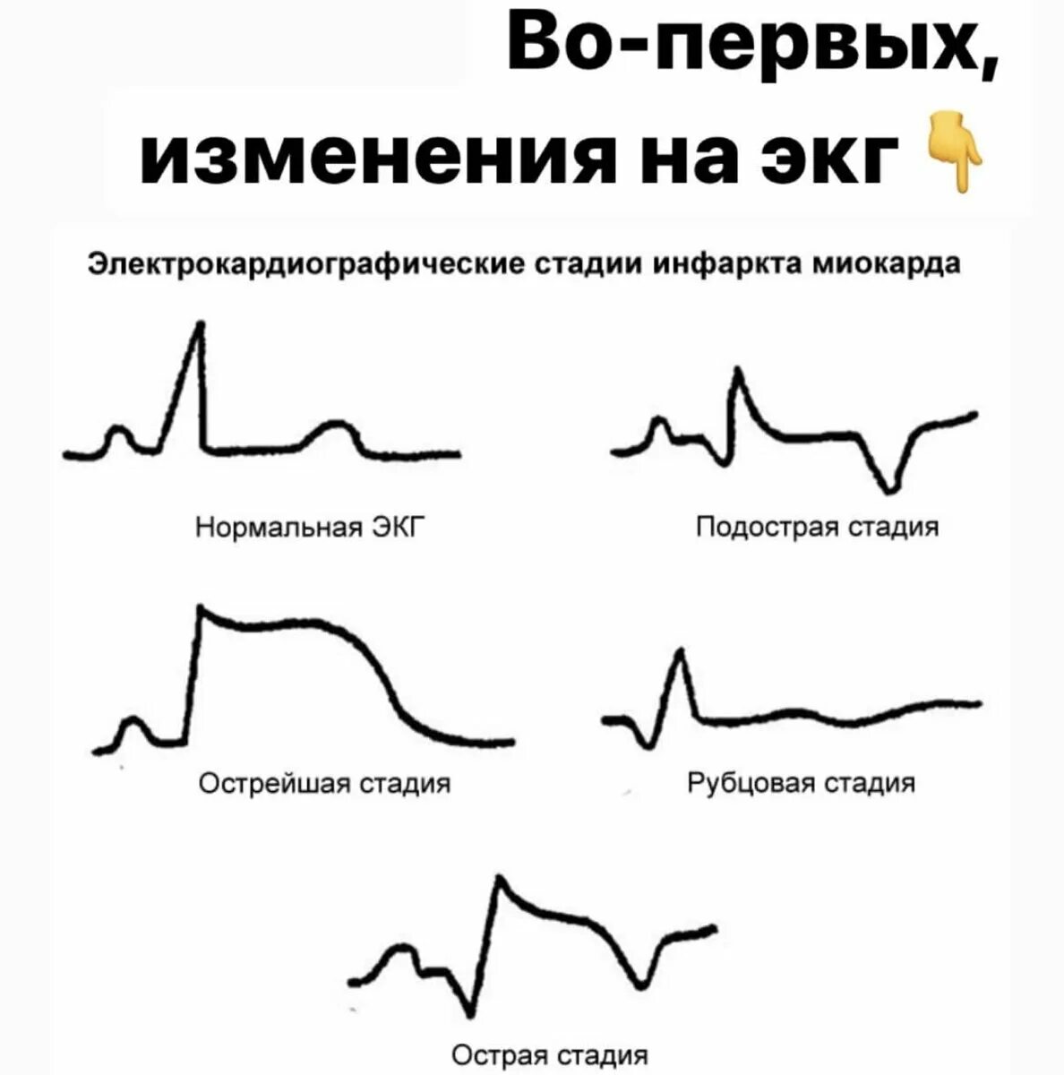 Кардиограмма сердца при инфаркте фото Инфаркт: почему иногда фатален, а иногда случайно находят при диспансеризации? Д