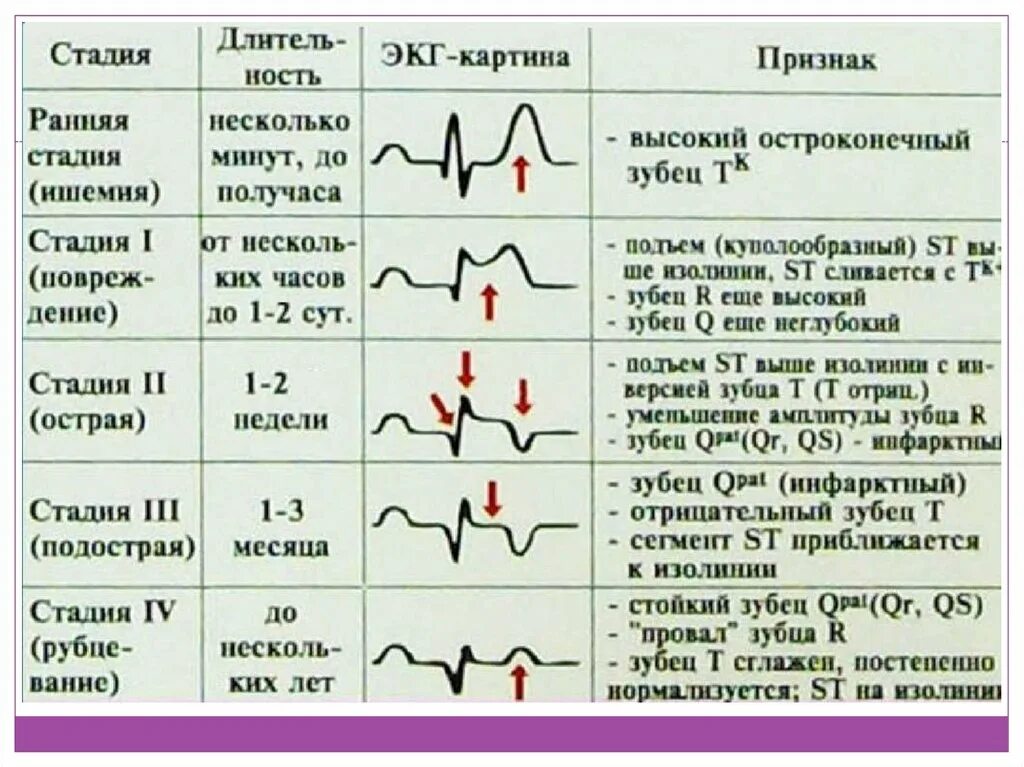 Кардиограмма сердца при инфаркте фото Стадии инфаркта на экг