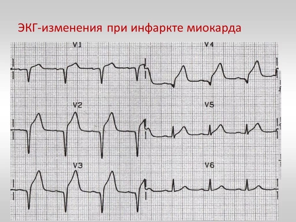 Кардиограмма сердца при инфаркте фото Презентация "ЭКГ-диагностика при подозрении на инфаркт миокарда" - скачать проек