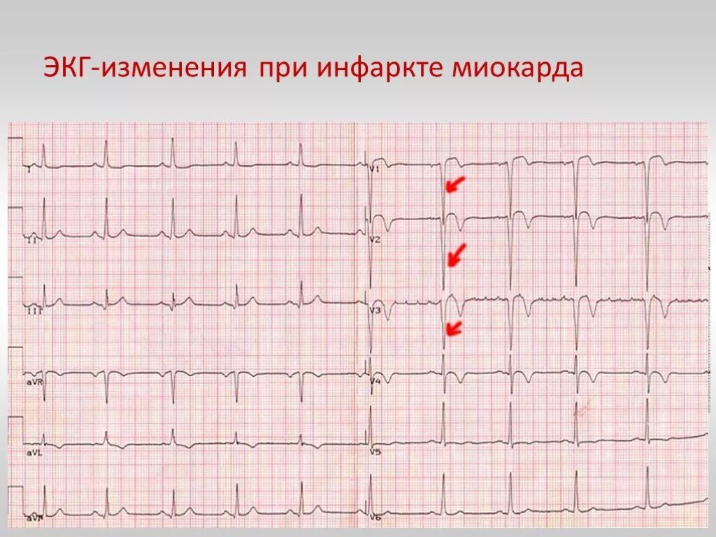 Кардиограмма сердца при инфаркте фото Покажет экг после - найдено 86 картинок