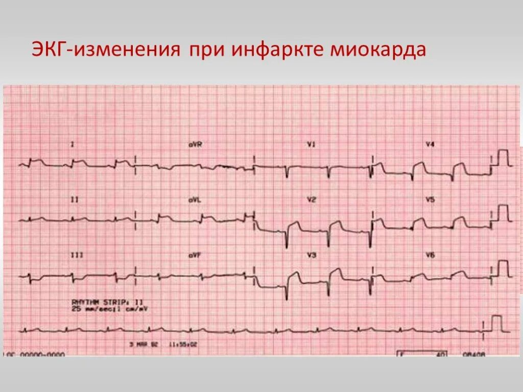 Кардиограмма сердца при инфаркте фото Покажет экг после