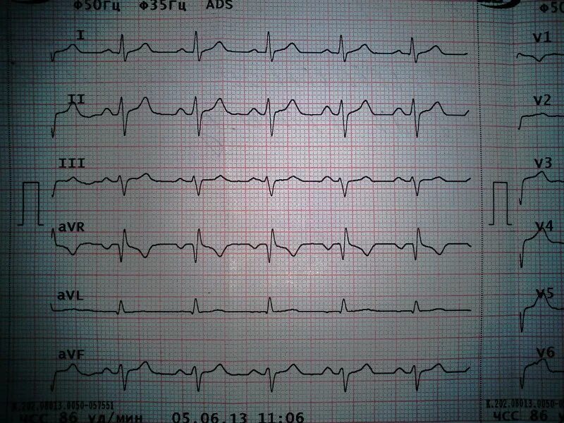 Кардиограмма сердца при инфаркте фото Расшифровать ЭКГ - Вопрос кардиологу - 03 Онлайн