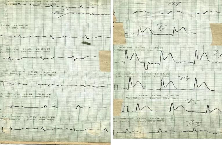 Кардиограмма сердца при инфаркте фото ЭКГ при инфаркте миокарда: признаки, локализация и расшифровка кардиограммы. Осо