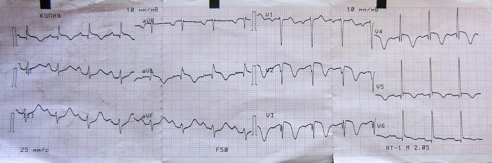Кардиограмма сердца при инфаркте фото Картинки ЭКГ МОЗГОВ