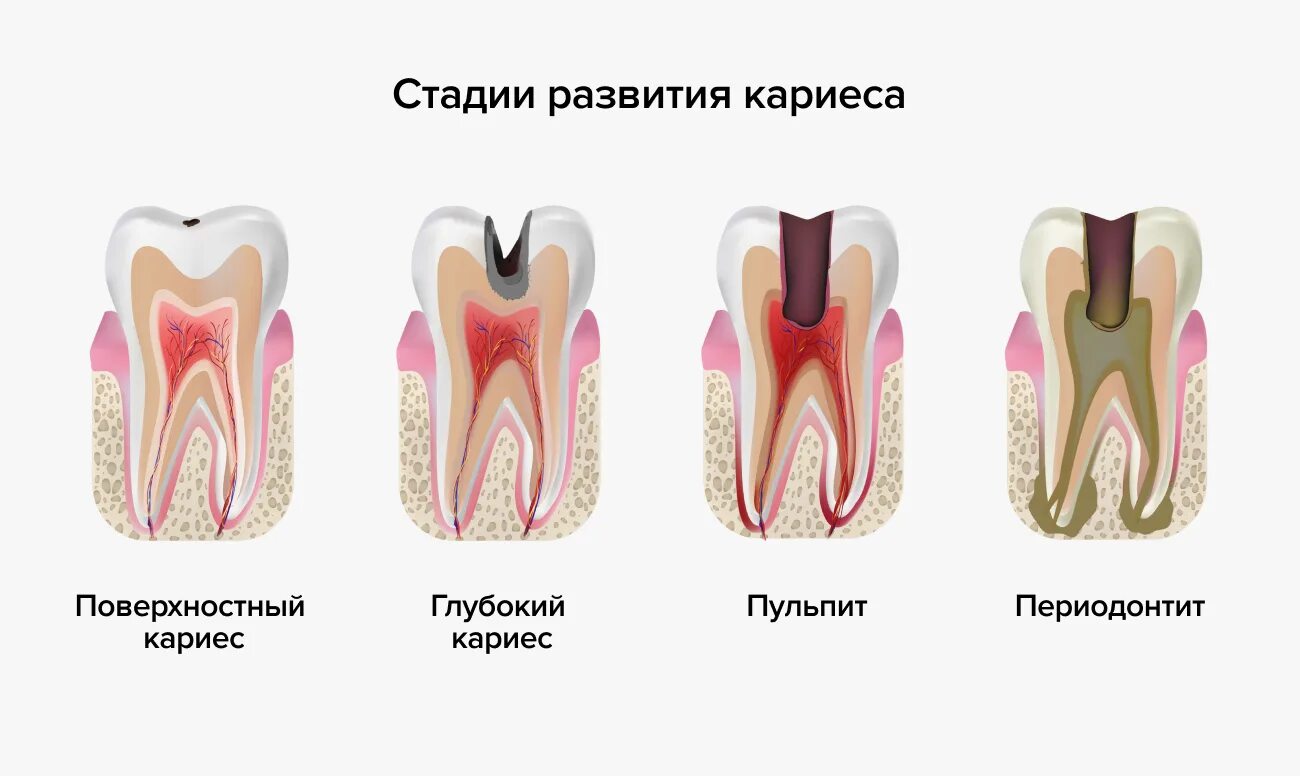 Кариес на ранней стадии фото Начальная стадия кариеса зубов