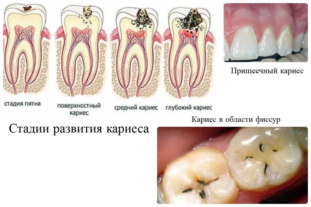 Кариес на ранней стадии фото Поверхностный кариес зубов: причины, симптомы, методы лечения и диагностики, про
