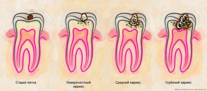 Кариес на ранней стадии фото Цены "Стоматологическая клиника Бонастом" в Красноярске - Яндекс Карты