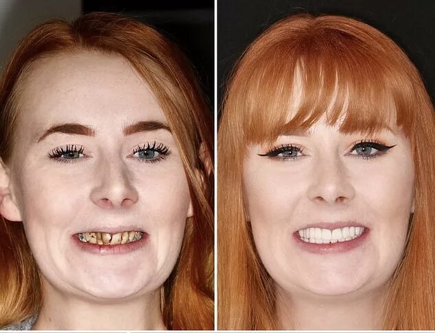 Кариес передних зубов фото у взрослых Woman, 26, told she would need full DENTURES to fix her decaying teeth