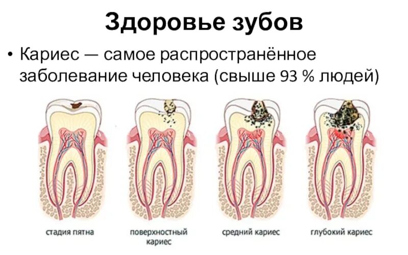 Кариес симптомы фото Болит голова после лечения зуба