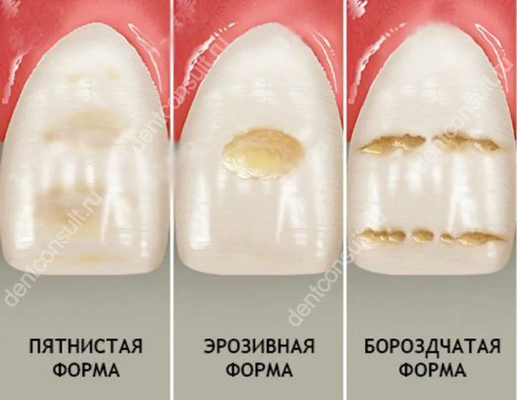 Кариес в стадии пятна фото Гипоплазия зубной эмали: виды патологии и причины появления