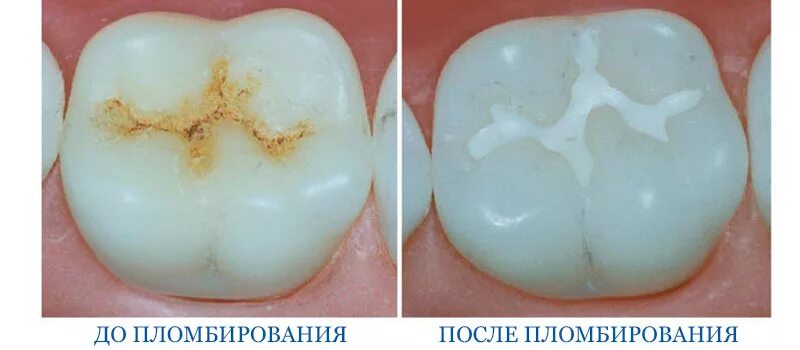 Кариес в стадии пятна фото Коронка или пломба Стоматология в Кудрово