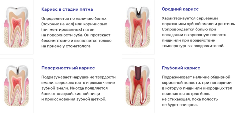 Кариес в стадии пятна фото Лечение кариеса в СПб Вылечить кариес "Премьера"