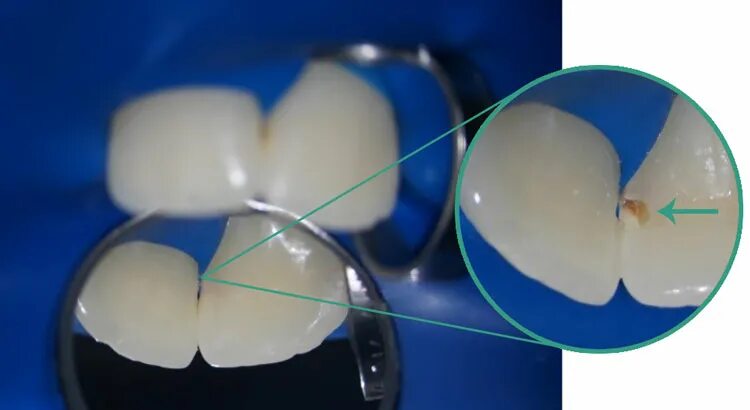 Кариес в стадии пятна фото Лечение зубов под дентальным микроскопом : зачем и основные преимущества метода,