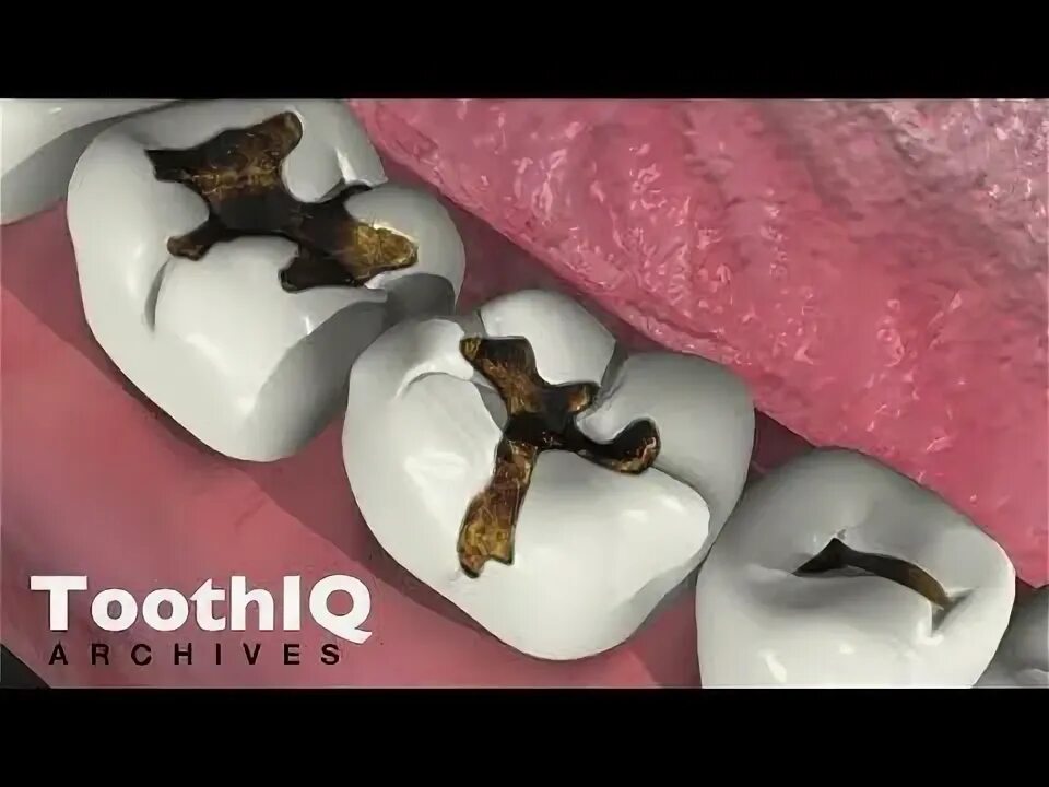 Кариес зубов фото Unwieldy Tooth Extraction Healing Pictures #dentistasfit #ToothExtractionHealing