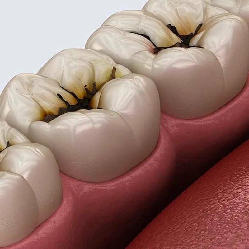 Кариес зубов фото Цены ProfDental на улице Мира в Мытищах, Москва - Zoon