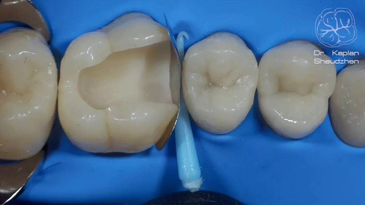 Кариозные зубы фото DentalПлюшки 11- адаптация матрицы - YouTube