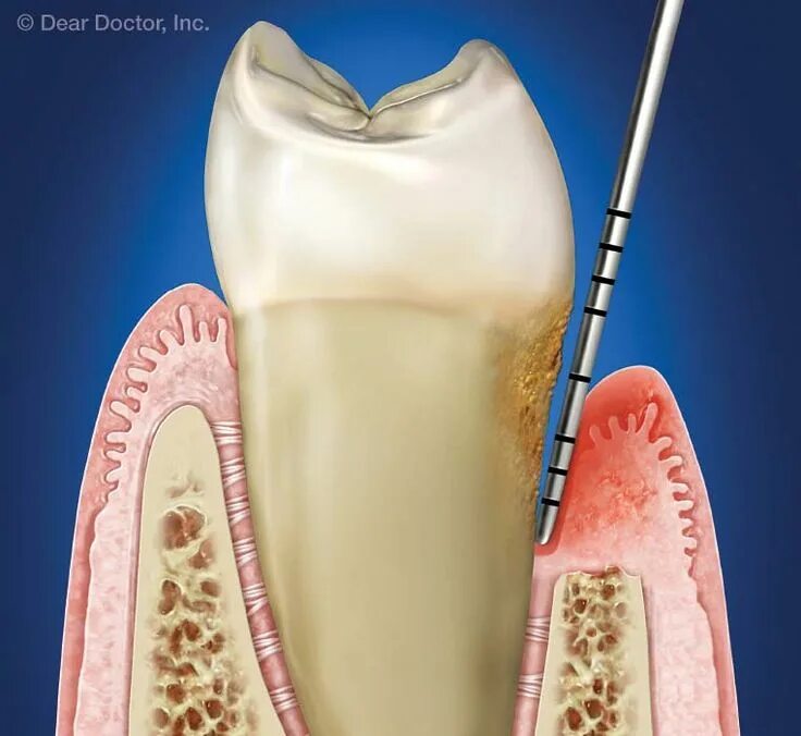 Карман зуба фото Pin on Periodonttitt