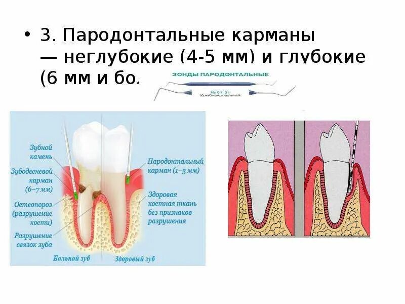 Карман зуба фото Индексная оценка CPITN - презентация, доклад, проект скачать