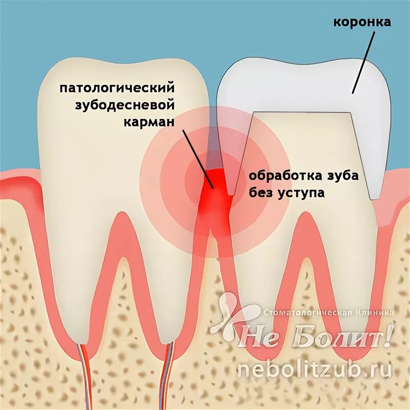 Карман зуба фото Болит десна, ноет зуб под коронкой при нажатии - Если болит зуб - Блог Стоматоло