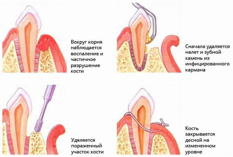 Карман зуба фото Кюретаж - очищение междесневых карманов