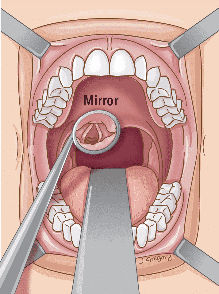 Карцинома горла фото What is Endoscopy * Cancer Basics * THANC Guide