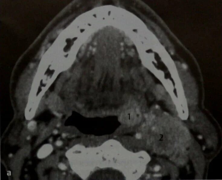 Карцинома горла фото МРТ и КТ пазух носа. Диагностика рака небной миндалины