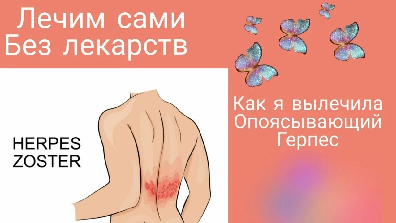 Картинки как выглядит опоясывающий лишай Как лечить герпес на теле. Опоясывающий герпес без лекарств. - YouTube