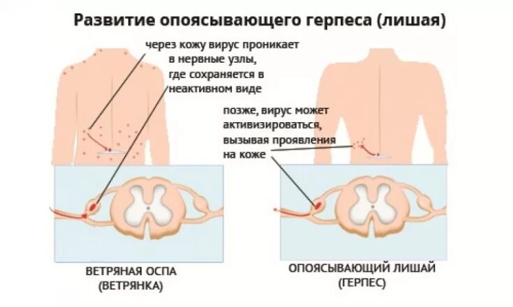 Картинки как выглядит опоясывающий лишай Клиническая картина и современные подходы к лечению опоясывающего герпеса - Este