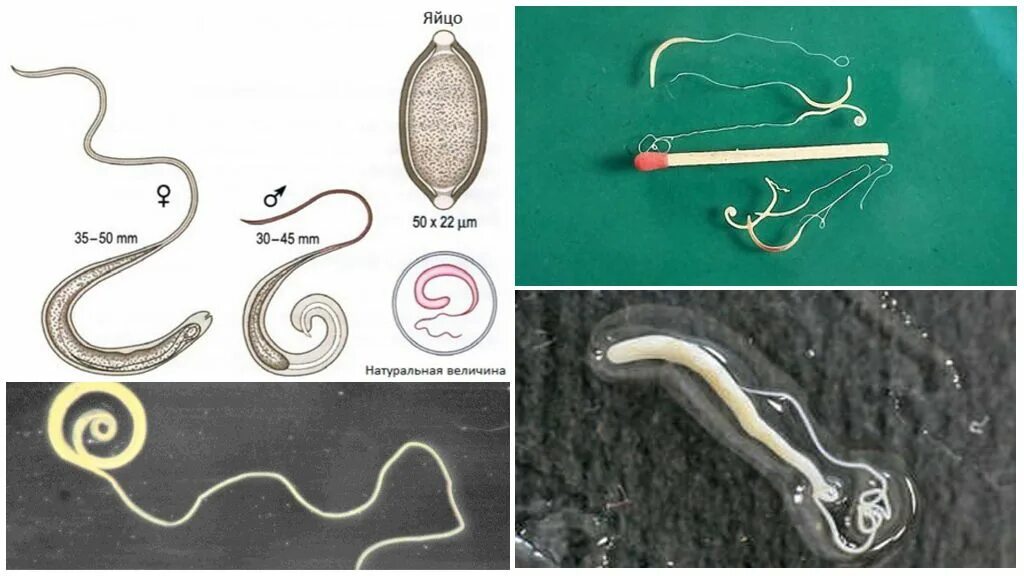 Картинки как выглядят глисты Виды глистов у человека - фото и описание