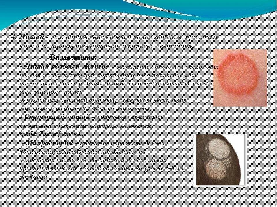 Картинки лишая у человека фото Стригущий лишай у человека. симптомы, причины, лечение для взрослых и детей
