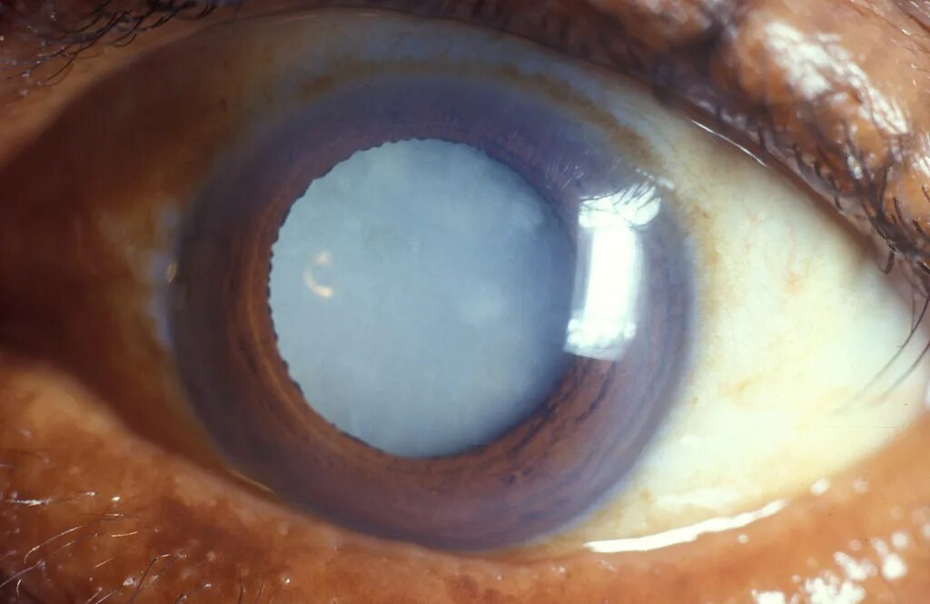 Катаракта фото глаза Mature cataract, no red reflex. © International Centre for. Flickr