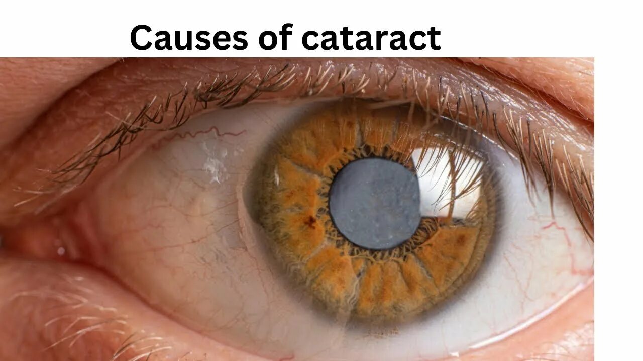 Катаракта фото глаза как выглядит у людей Top causes of cataract - YouTube