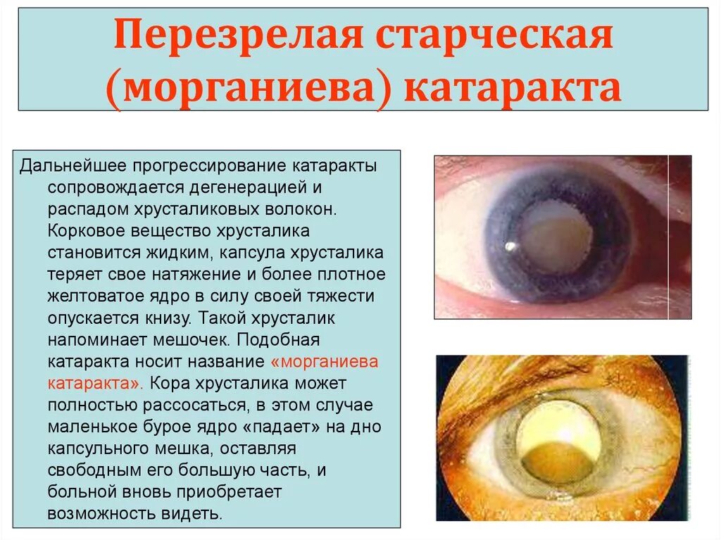 Катаракта симптомы фото Симптомы катаракты глаза: найдено 78 изображений