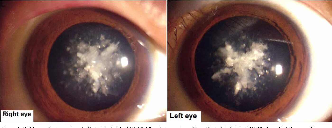 Катаракта симптомы фото PDF Mutation G61C in the CRYGD gene causing autosomal dominant congenital corall