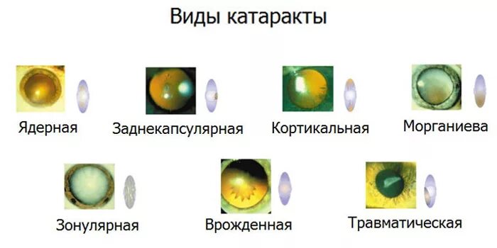 Катаракта цветок как выглядит Катаракта - симптомы, диагностика, лечение болезни глаз