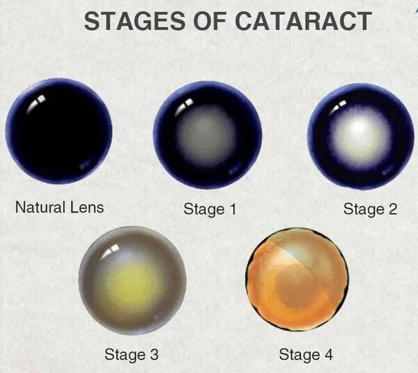 Катаракта цветок как выглядит Катаракта: причины, симптомы, лечение и профилактика в статье офтальмолога-хирур