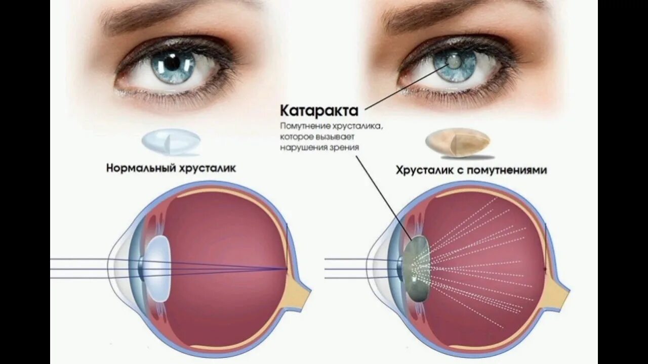 Катаракта цветок как выглядит КАТАРАКТА. НЕ ДАЙ СЕБЕ ОСЛЕПНУТЬ... - YouTube